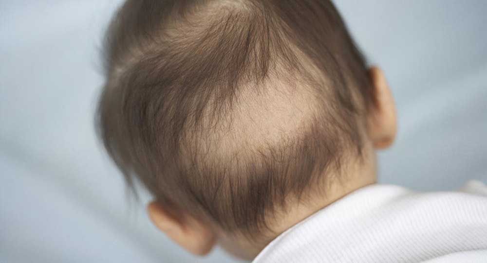 دلیل ریزش موی کودکان