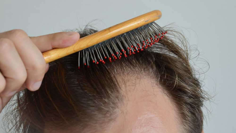 درمان کم پشتی موها