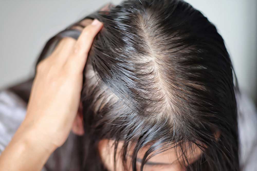 راه های درمان خارش سر و ریزش مو