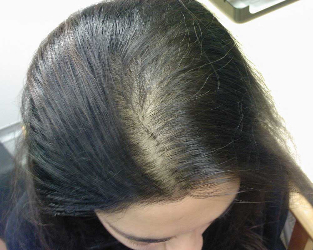 اختلالات هورمونی در ریزش مو