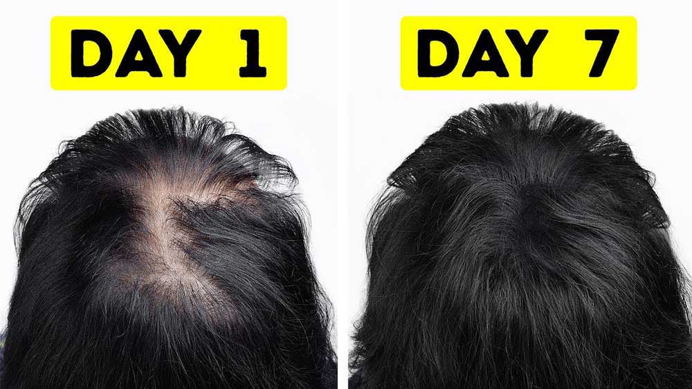 قبل و بعد درمان ریزش مو