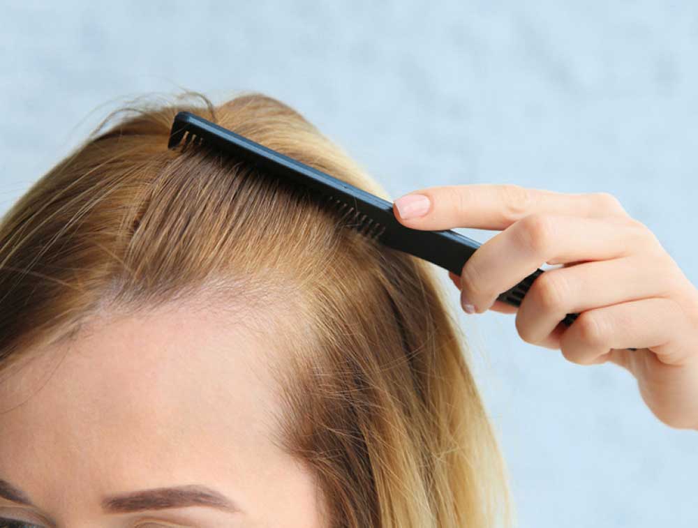 ریزش موی ارثی در زنان