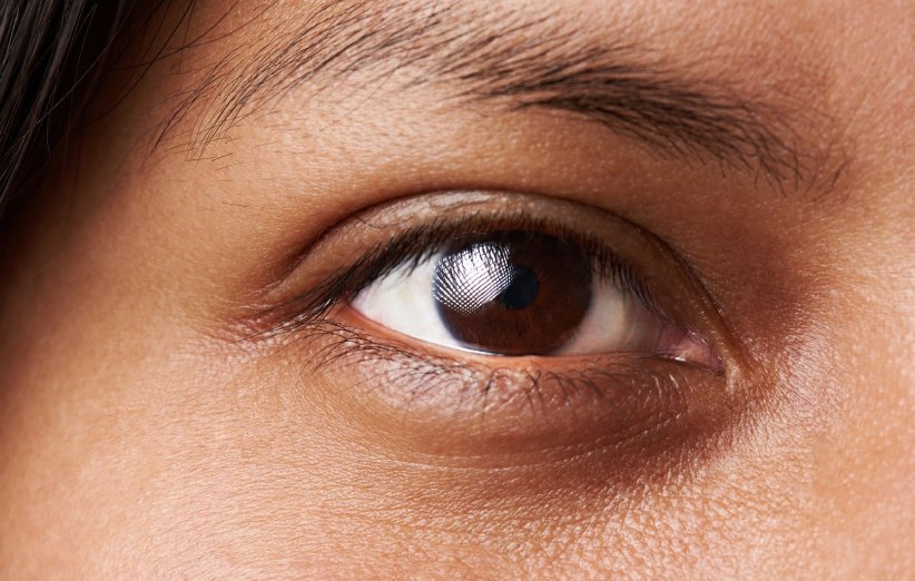 عوامل موثر در سیاهی دور چشم