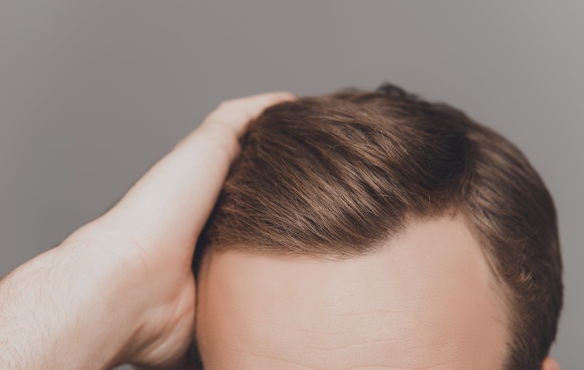 درمان ریزش مو با استفاده از شامپوهای مناسب